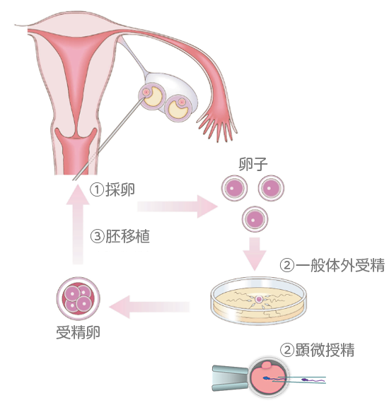 ①採卵 ②一般体外受精or顕微授精 ③胚移植　④採卵