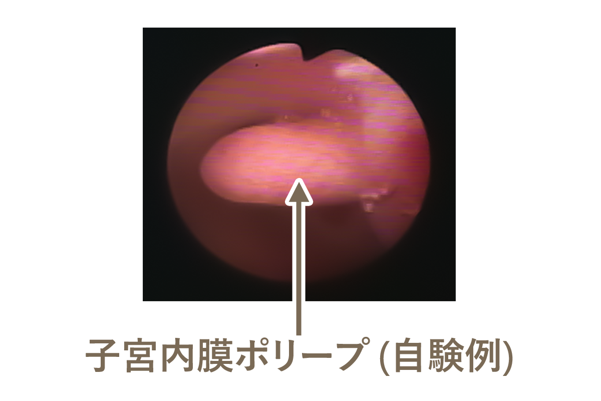 子宮内膜ポリープ（自験例）の写真