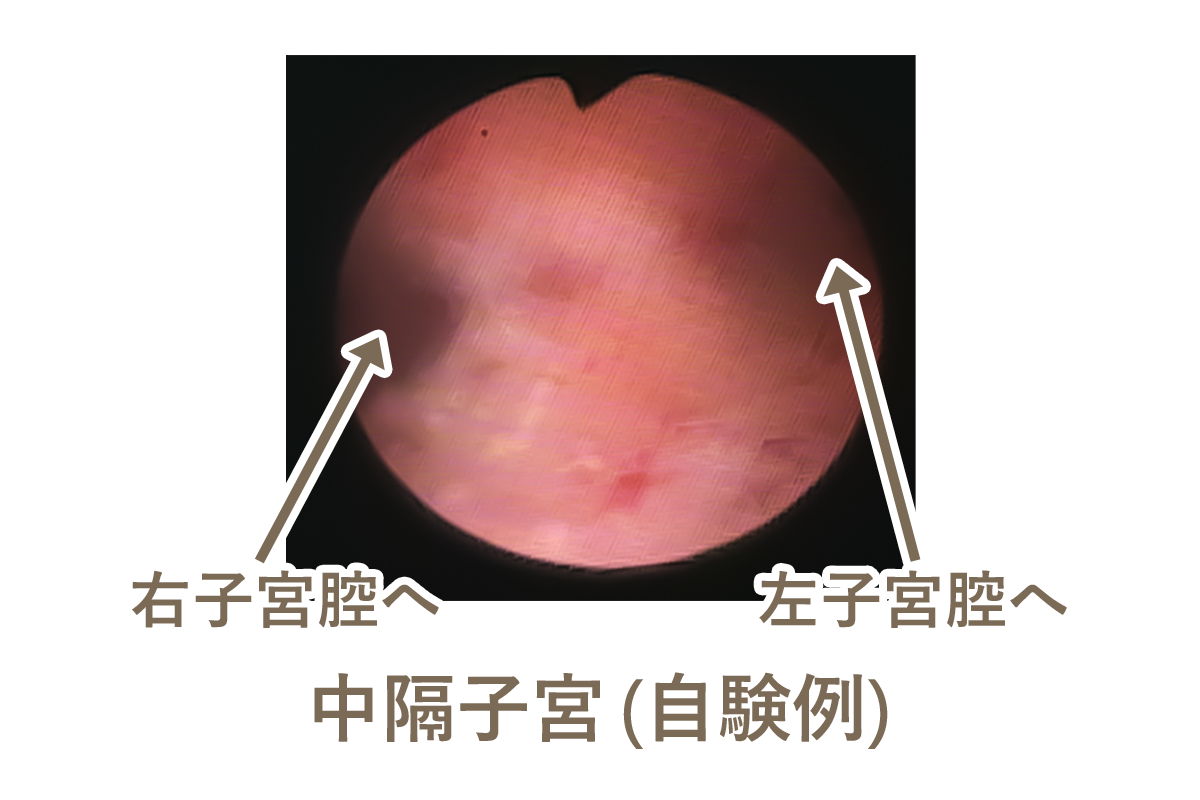 中隔子宮（自験例）の写真