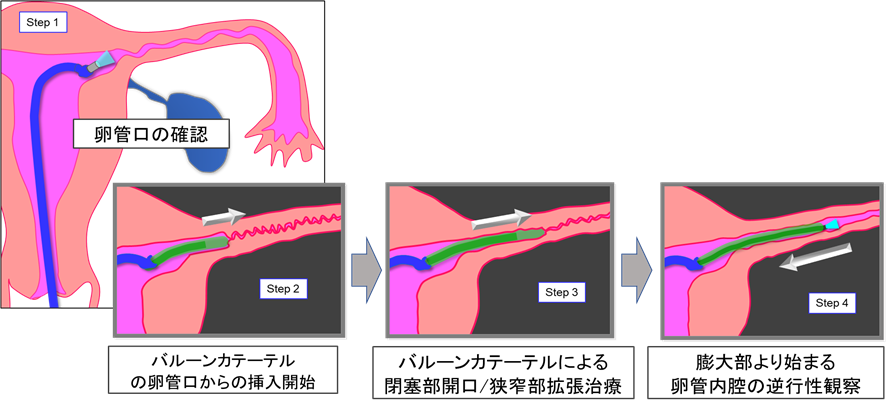 Step1:卵管口の確認。Step2:バルーンカーテルの卵管口からの挿入開始。Step3:バルーンカテーテルによる閉塞部開口/狭窄部拡張治療。Step4:膨大部により始まる卵管内腔の逆行性観察。