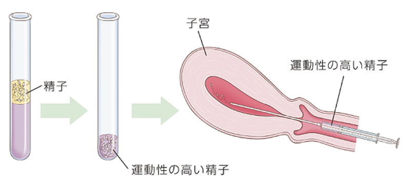 人工授精イメージ図